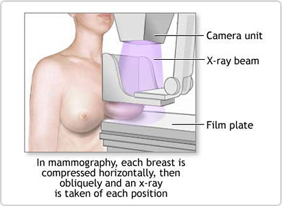 Diagnosis of Breast Cancer through Mammography