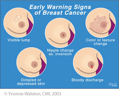 Breast Cancer Symptoms