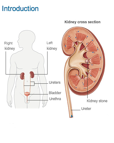 Kidney Stones