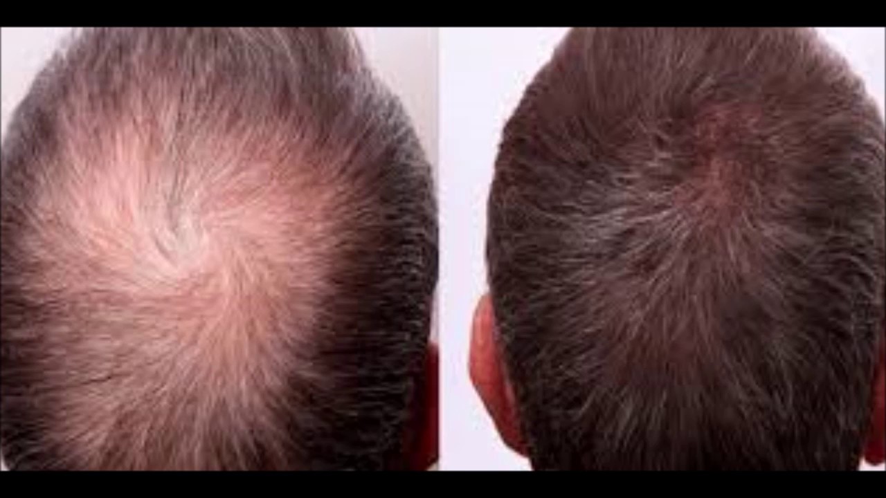 Hairloss? Is Minoxidil Foam Better than Minoxidil Liquid