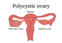 PCOS